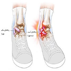 درمان رگ به رگ شدن و پیچ خوردن (کشیدگی تاندون) مچ پا بدون جراحی