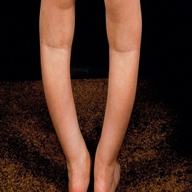 درمان پای پرانتزی در سنین مختلف با بریس،ماساژ درمانی و حرکات اصلاحی