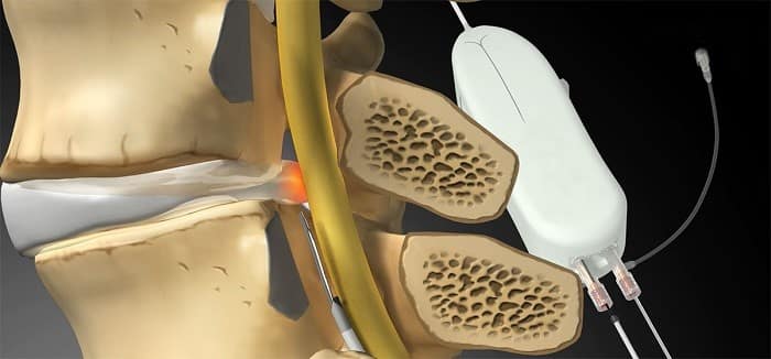 عمل دیسک با لیزر