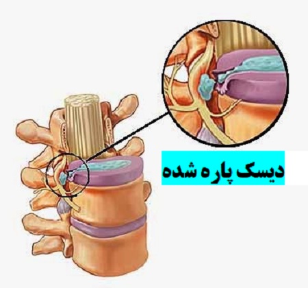 پارگی یا فتق دیسک به چه معنا است